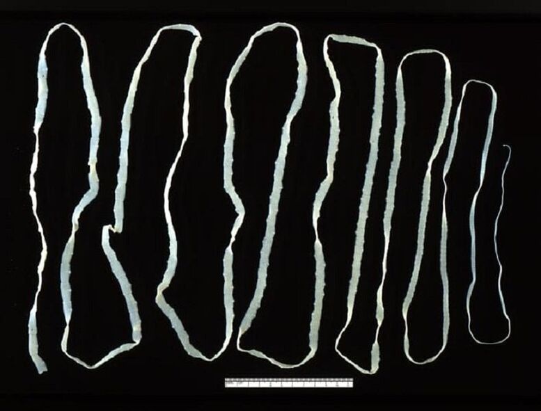 Ribbon removed from human intestine